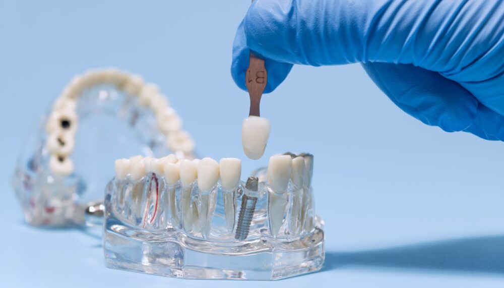 Dental Implants Ponte Vedra Beach
