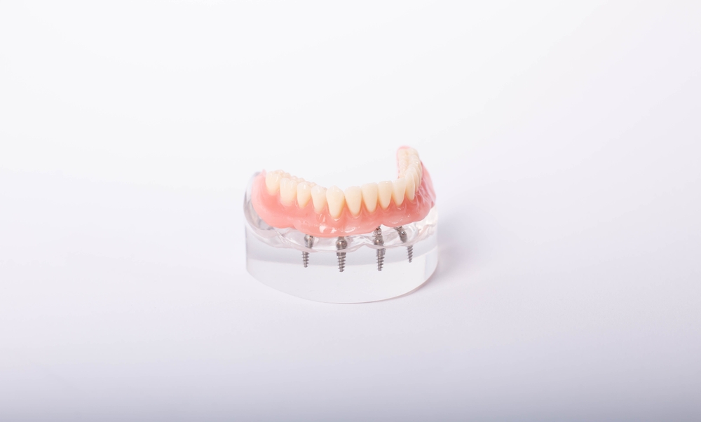 Implant-Supported Dentures Ponte Vedra Beach